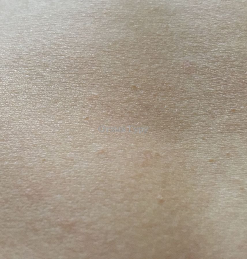 Гемангиома кожи: через 3 месяца после удаления