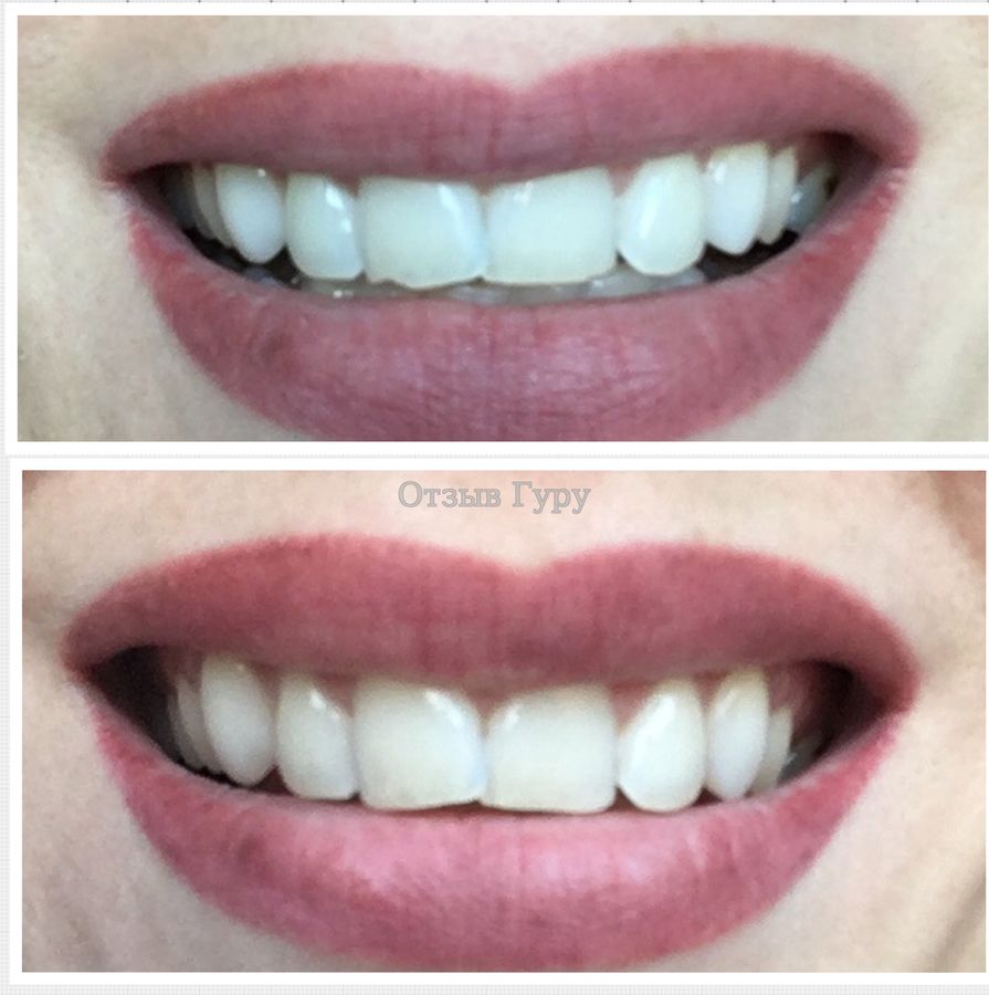 Наращивание зубов фото до и после