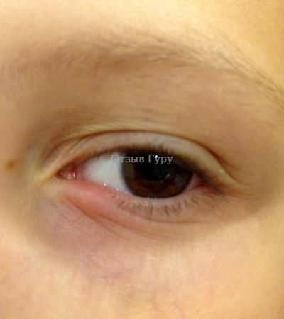 Блефарит. Глаз до лечения глазными каплями Тобрекс