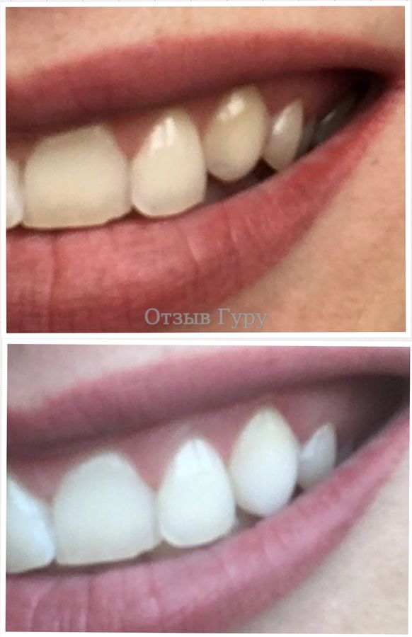 Реставрация зубов фото до и после