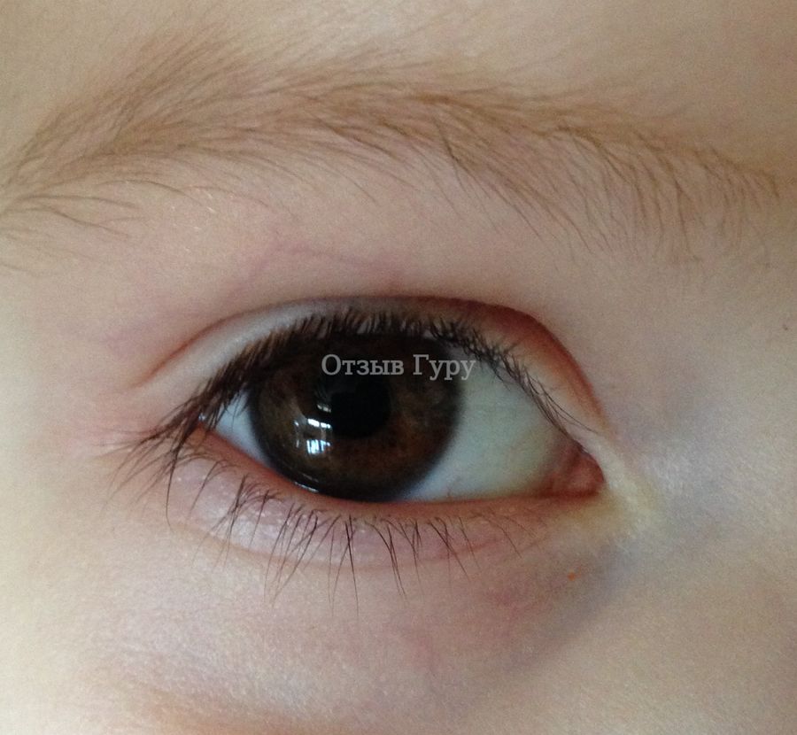 Глаз после лечения Флоксалом